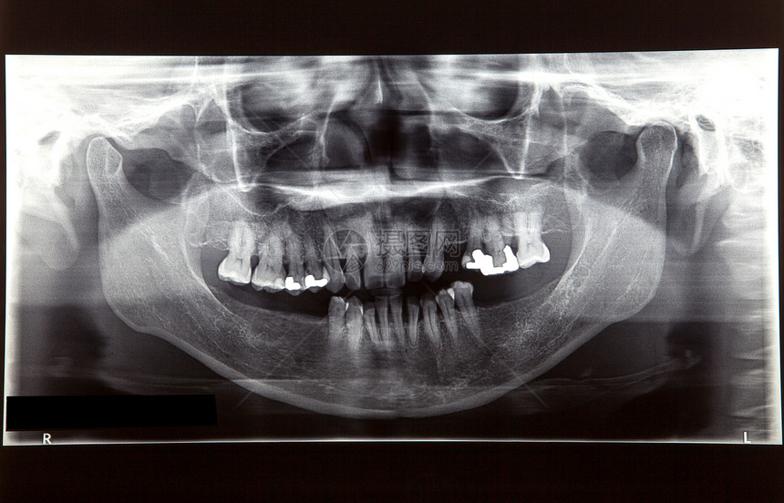 牙科护理概念的X光片图片