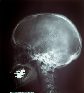 人体头骨X光胶片图片