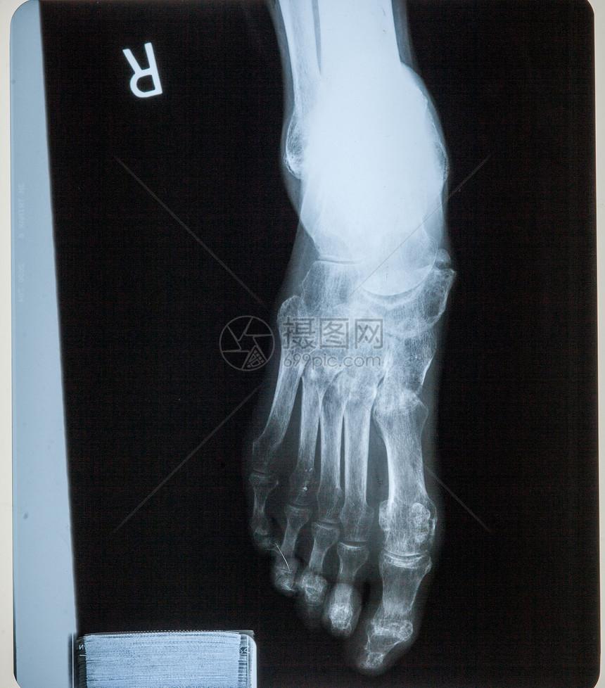 人手和双腿X光胶片图片