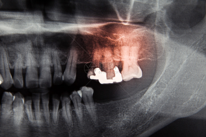 牙科护理概念的X光片图片
