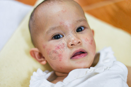 婴儿湿疹婴儿面部过敏背景