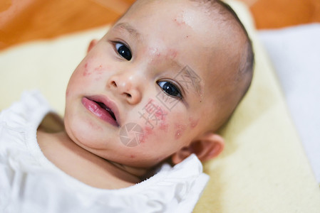 婴儿湿疹Rash婴儿面部过敏有病的面部过敏脸背景