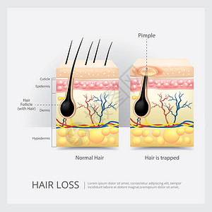 毛发结构毛发损失结构矢量说明插画