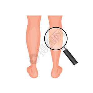 腿部血管血管变动和正常腿部问题的放大概念插画