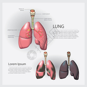 肺和部详细癌矢量说明图片