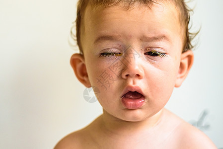 婴儿过敏一只有细菌净化脑炎的婴儿眼睛背景