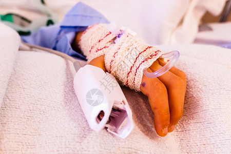 医院的脉搏被抢走婴儿捆绑住手图片