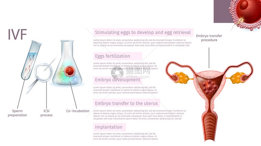 在体外受精阶段Sperm准备刺激鸡蛋ICSI进程Emplyo开发联合孵化转移到Uterus植入现实矢量医学封条复制空间图片