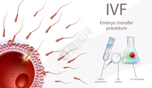解释说明体外授精Embryo移植程序IVF过程图附有说明和标Sperm准备ICSI过程联合孵化现实矢量说明医疗容器体外授精EmplyoE插画