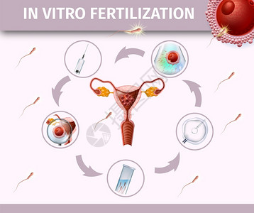 与舞台IVF图标相环绕的中心带有Uterus前视线的活体受精彩色海报Spermatozons流向雌卵细胞矢量现实说明Banner背景图片