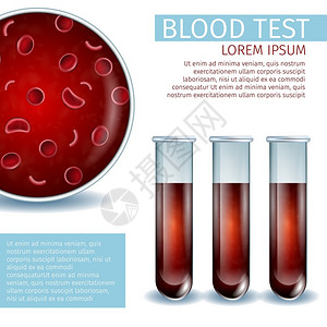 血液分析含有血红色细胞的宏视图以及带有液体血样本的一组实验室玻璃管子真实的矢量说明带有复制空间的广场血热医学禁闭器血液医学禁闭器复制空间插画