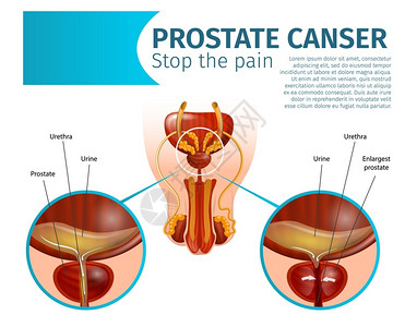 癌变前列腺癌肿瘤细胞男泌尿生殖系统疾病健康和受感染器官现实的病媒解剖计划禁闭室复制空间止痛Gland的癌症肿瘤细胞插画