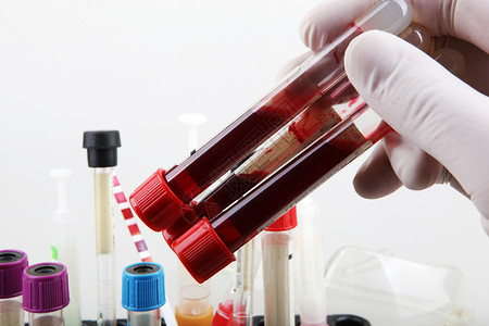 你最出彩新冠新冠19研究血液测试定期验血是跟踪你整体身健康状况的最重要方法之一背景