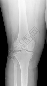 KneeXRay的图像检测放射科KneeOsteoarthyl炎图片