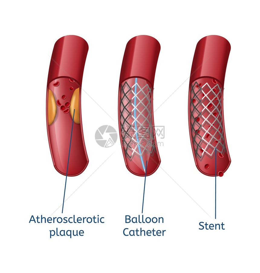关闭船只解剖和现代方法气球导管和口服治疗病媒说明医技术保健概念消除神龙体硬化现实演示图片