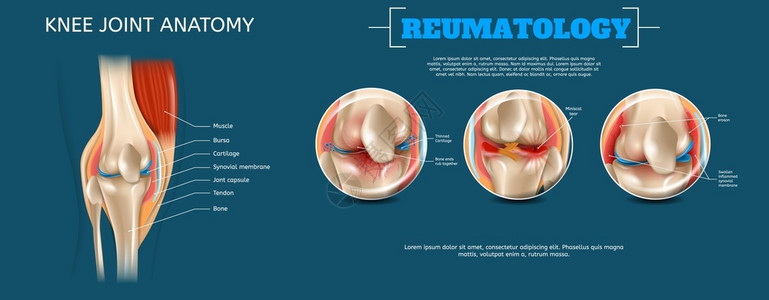 拉紧3d矢量再生图像组成要素结构人膝联合肌肉BursaCartilageSynovialMembraneJontCapsuleTen插画