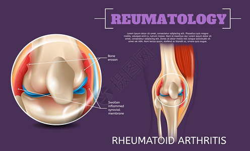 3d矢量图像再生机解剖人体膝关节炎医学可视长期耐久膝伤害外观研究结构科问题合腿插画