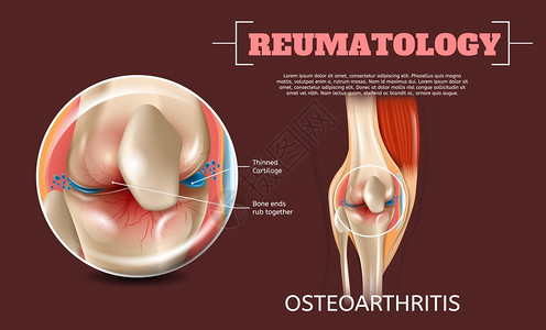 膝关节疼3dBannerVictor图像病变人体解剖膝关节插画