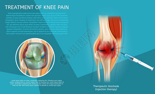 刚度3d矢量图像Banner治疗裂缝人体膝关节Syringe注射医疗海报程序和注射治疗结果插画