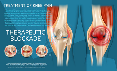 关节炎海报3d矢量图像Banner治疗裂缝人类膝关节在医疗治前后查看插画