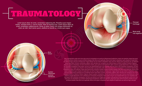 日式豚骨面海报3dVectorBanner图像人体解剖膝关节影响和治疗伤害插画