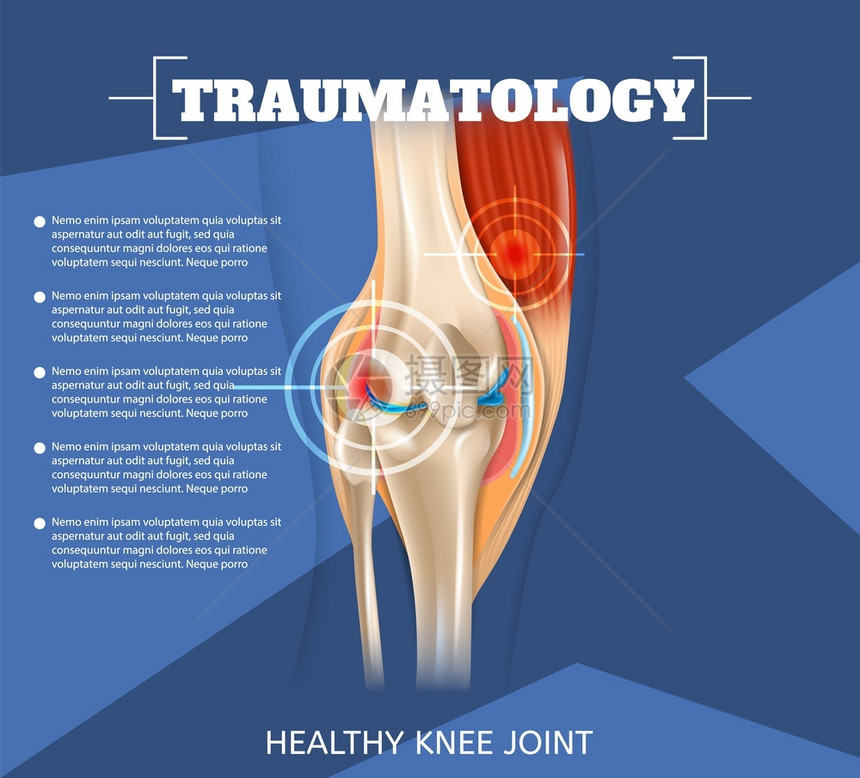 3dVectorBanner图像解剖人类健康膝合治疗Inflogs联合治疗方法创伤专门医学图片
