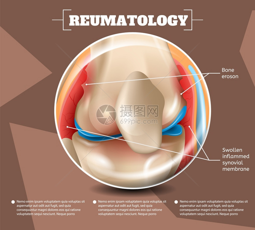 3d矢量图像导体解剖医学结构类型伤害和疾病BoneEroson肿胀的InflammedSynovialMembrane人类膝关节图片