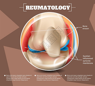导体结构3d矢量图像导体解剖医学结构类型伤害和疾病BoneEroson肿胀的InflammedSynovialMembrane人类膝关节插画