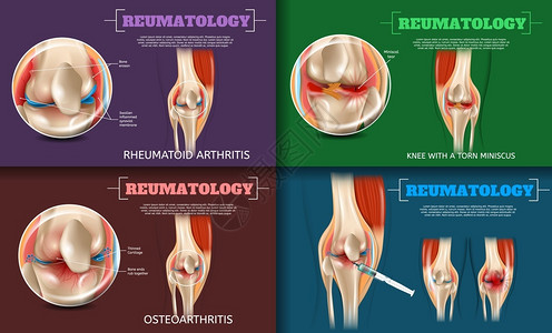 关节炎海报3dBannerVectorSet图像病理医学问题和膝关节疾病插画