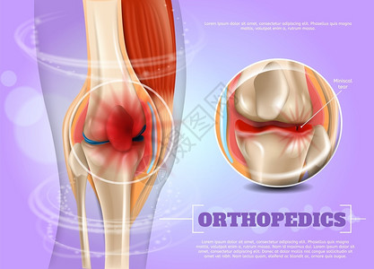 软骨损伤3dBannerVictor图像闭合解剖和人体膝盖结构联合插画