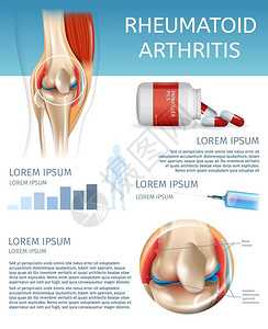 药物联合3dBannerVictorI说明人体膝盖联合疾病信息治疗药物注射以缓解疼痛插画