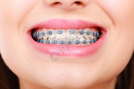 特写镜头享受妇女微笑用蓝色牙套露出白背景