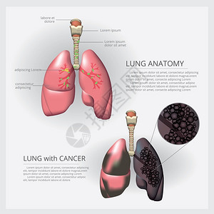 致癌物肺癌图解矢量说明插画