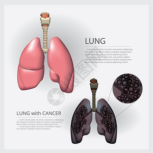 肺癌图解矢量插画图片