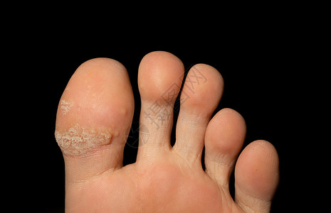 在医疗保健治概念中紧的人体皮肤脚指在后背景中被隔离高清图片