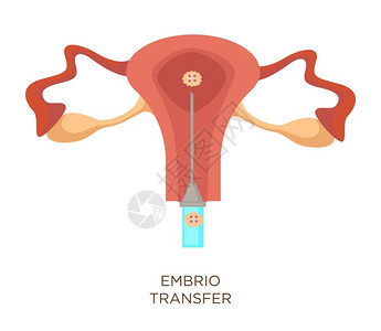 子房Uterus和胚胎转移人工授精孤立女器官体外授精孕育现代医药注射器和生殖系统外科手术胚胎转移人工授精子宫和卵孤立器官插画