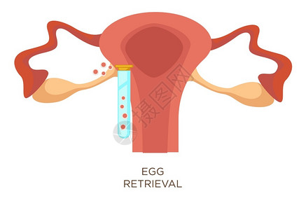 卵巢囊肿体外受精卵回收阶段人工受精病媒子宫和用卵雌生殖系统的试验管进行人工受精的子宫以及用卵女生殖系统进行测试的卵子女生殖系统的解剖育能插画