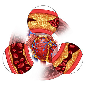 心脏动脉疾病和冠状体医学概念是逐渐形成的板块造堵塞的动脉和无神体硬化与带有3D插图元素的胆固醇人体解剖一样背景图片