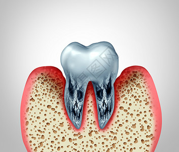 3d人体素材3D说明由于细菌感染以及骨骼腐烂和口香糖炎的洞穴或牙齿口腔疾病和垂口腔卫生问题很差背景