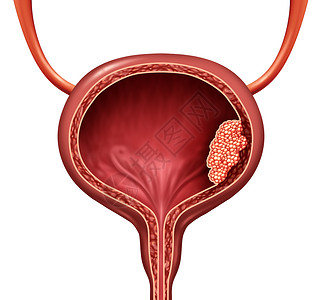 膀胱肿瘤人体膀胱癌是一种尿道解剖器官疾病恶细胞概念是3D插图切除身体解剖背景