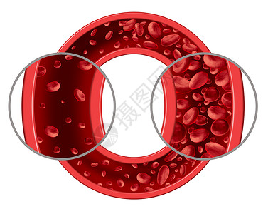 贫血和病医学图表概念是正常和异的血细胞计数动脉或血管中的人体循环是3D插图孤立在白色背景上背景图片