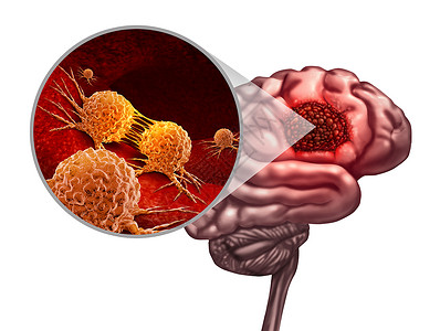脑癌解剖概念和恶肿瘤或象征作为神经学身体的一部分恶细胞以3D插图元素分裂和扩散的微放大作用背景图片