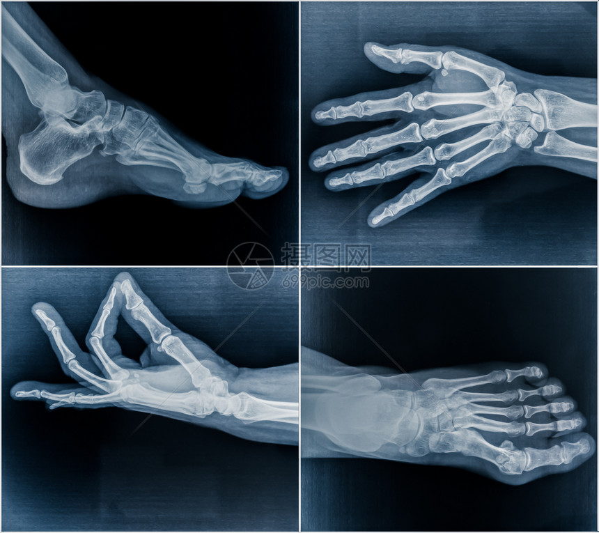 50岁妇女的手脚X光扫描图片