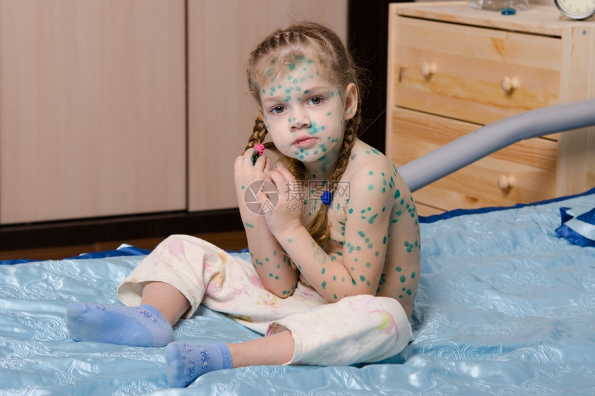 患有天花的小女孩被绿点覆盖小女孩被躺在床上的天花绿色痕迹覆盖图片