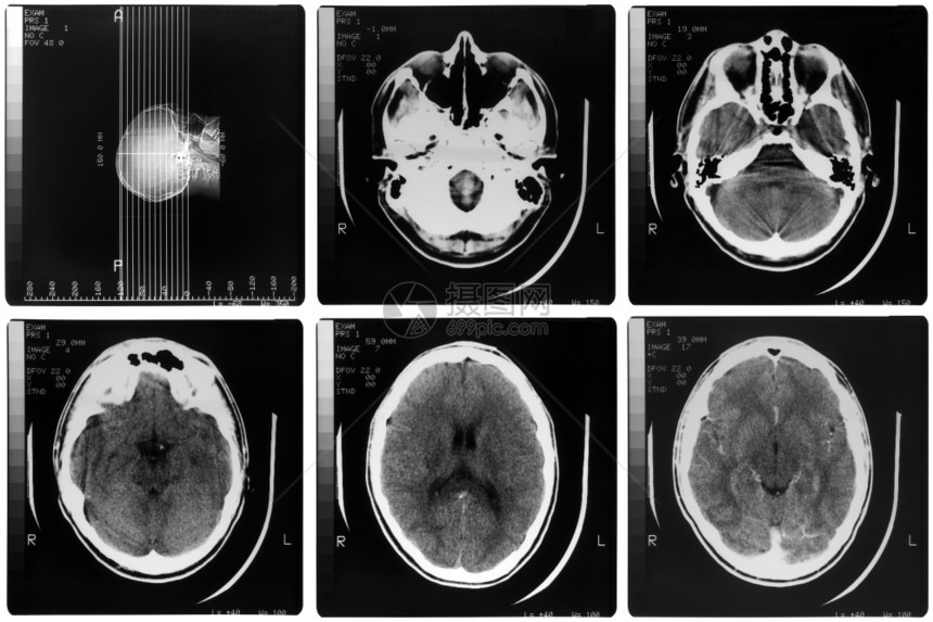 医疗X光人体脑骨头的医学X光成像图片