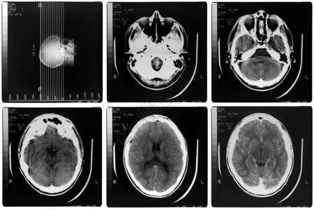 医疗X光人体脑骨头的医学X光成像图片