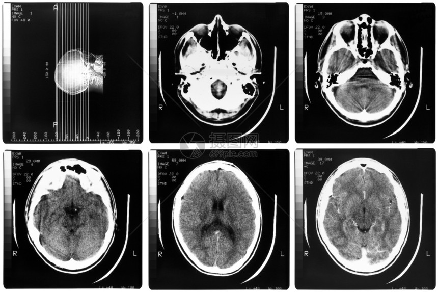 医疗X光人体脑骨头的医学X光成像图片