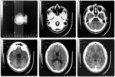 医疗X光人体脑骨头的医学X光成像图片