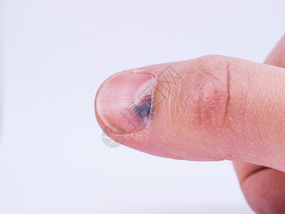 指甲下的亚脑血肿指甲下迹收集指甲下血迹或网球脚趾图片