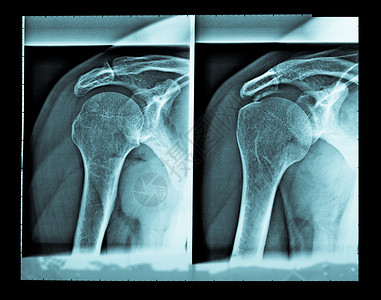 骨骼线X光用于骨骼诊断放射学的肩部X线成像医学X冷血球型背景